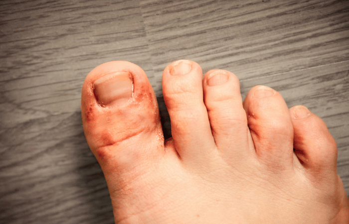 Schuhe bei Fußpilz richtig reinigen: So vermeiden Sie Pilzinfektionen ...